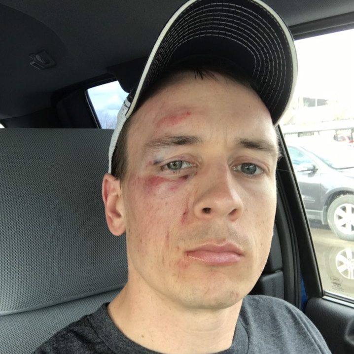 Scott shows off a bruised face and black eye after crashing at the Prattsburg Gravel Classic 2019